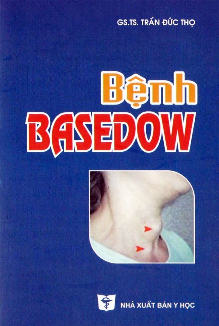 Bệnh Basedow
