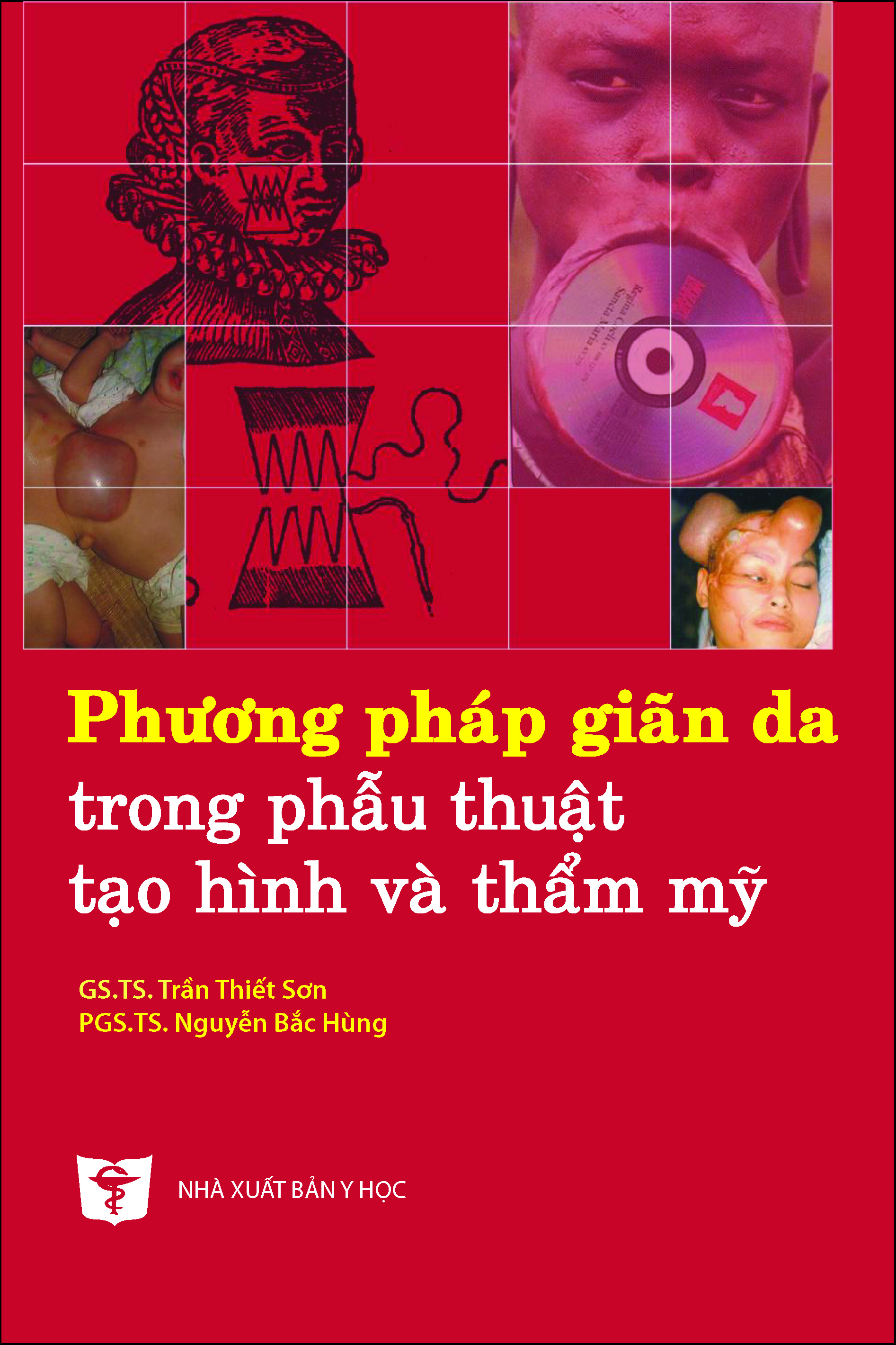 Phương pháp giãn da trong phẫu thuật tạo hình và thẩm mỹ