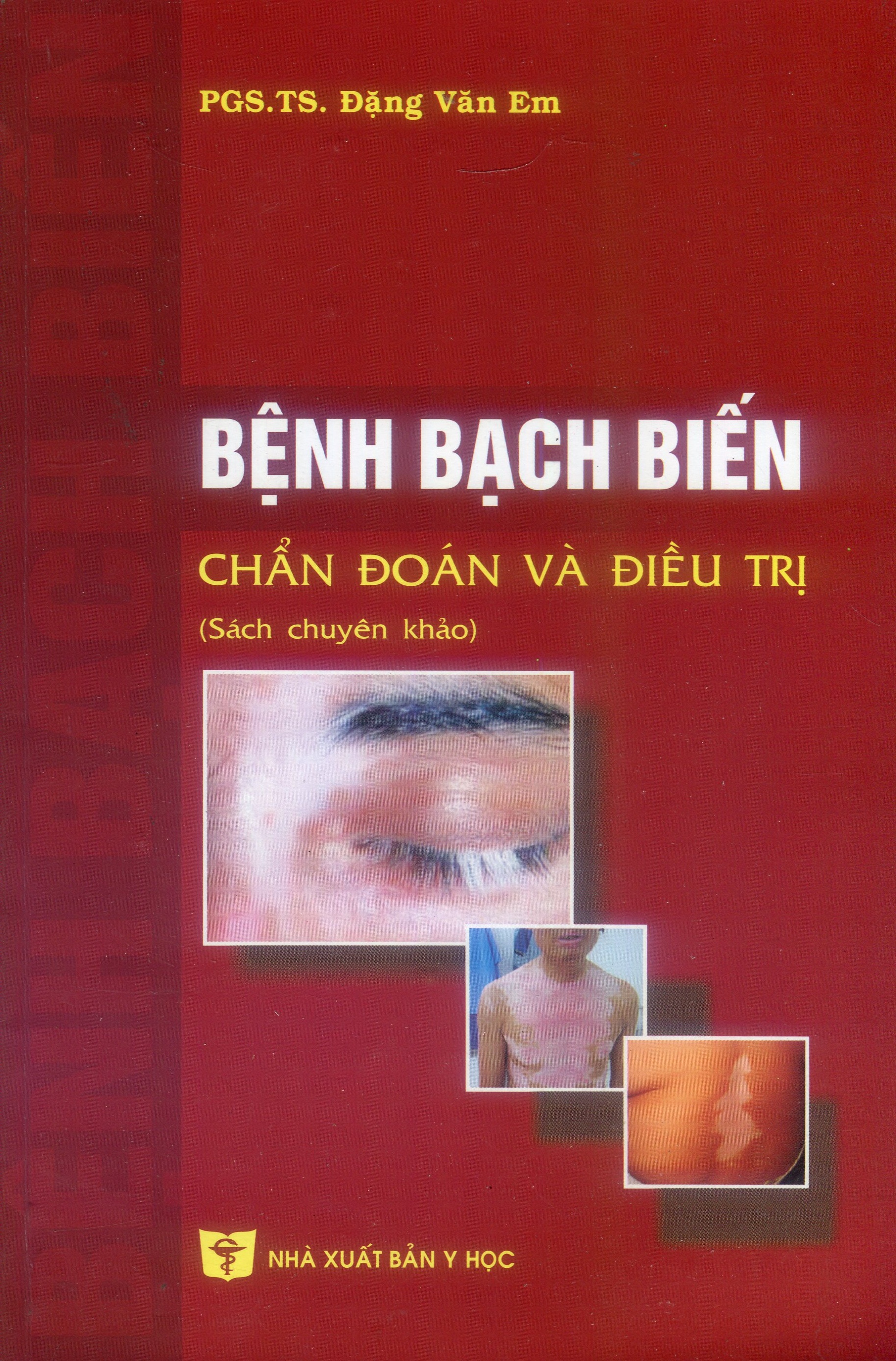 Bệnh bạch biến - chẩn đoán và điều trị