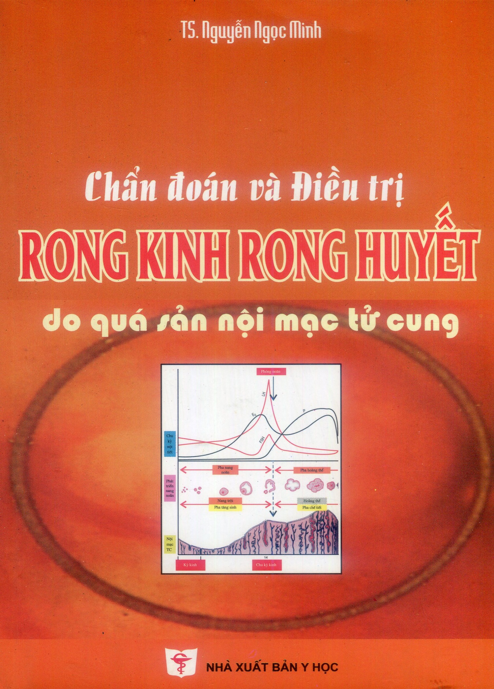 Chẩn đoán và điều trị rong kinh, rong huyết do quá sản nội mạc tử cung