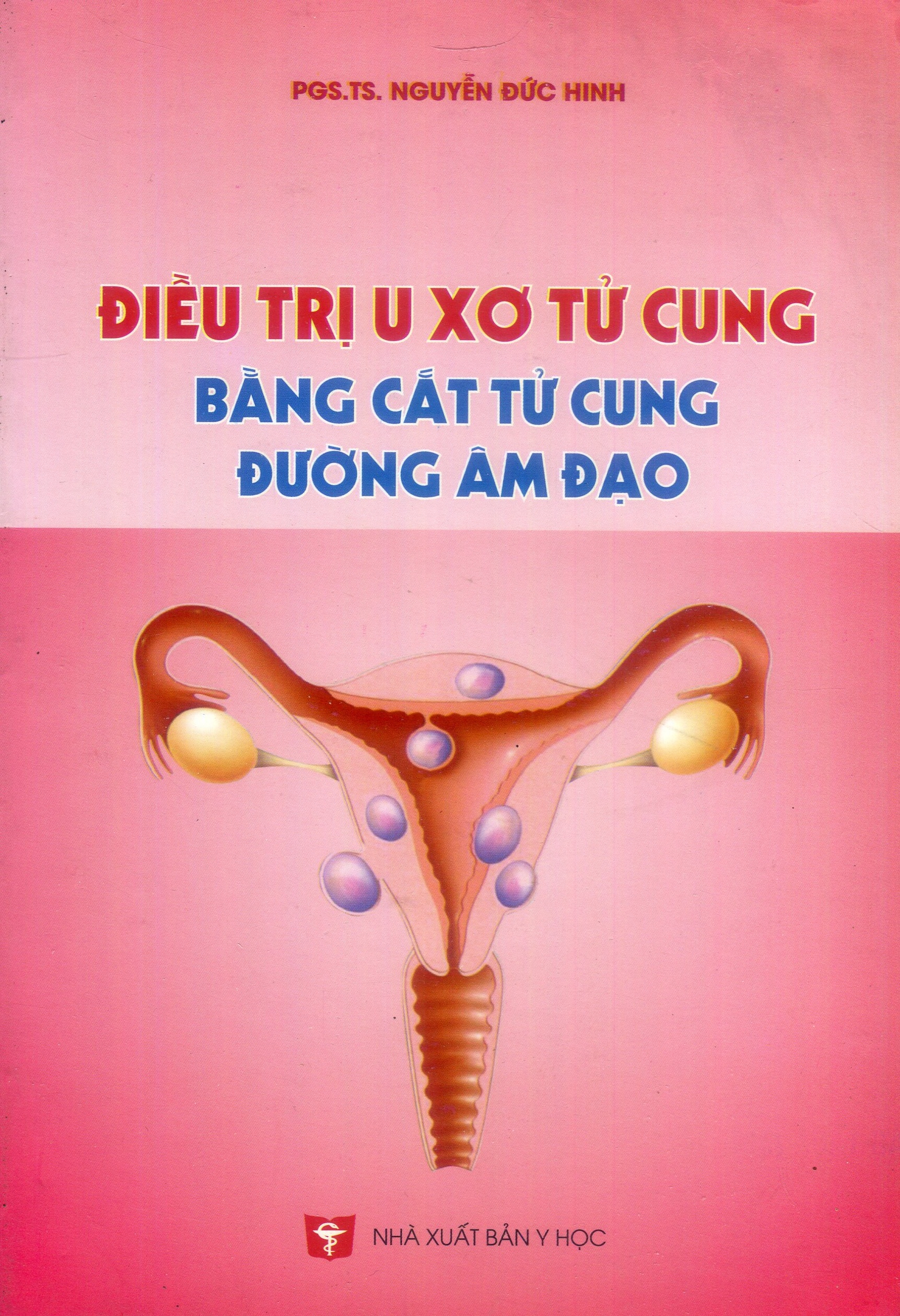 Điều trị u xơ tử cung bằng cắt tử cung đường âm đạo