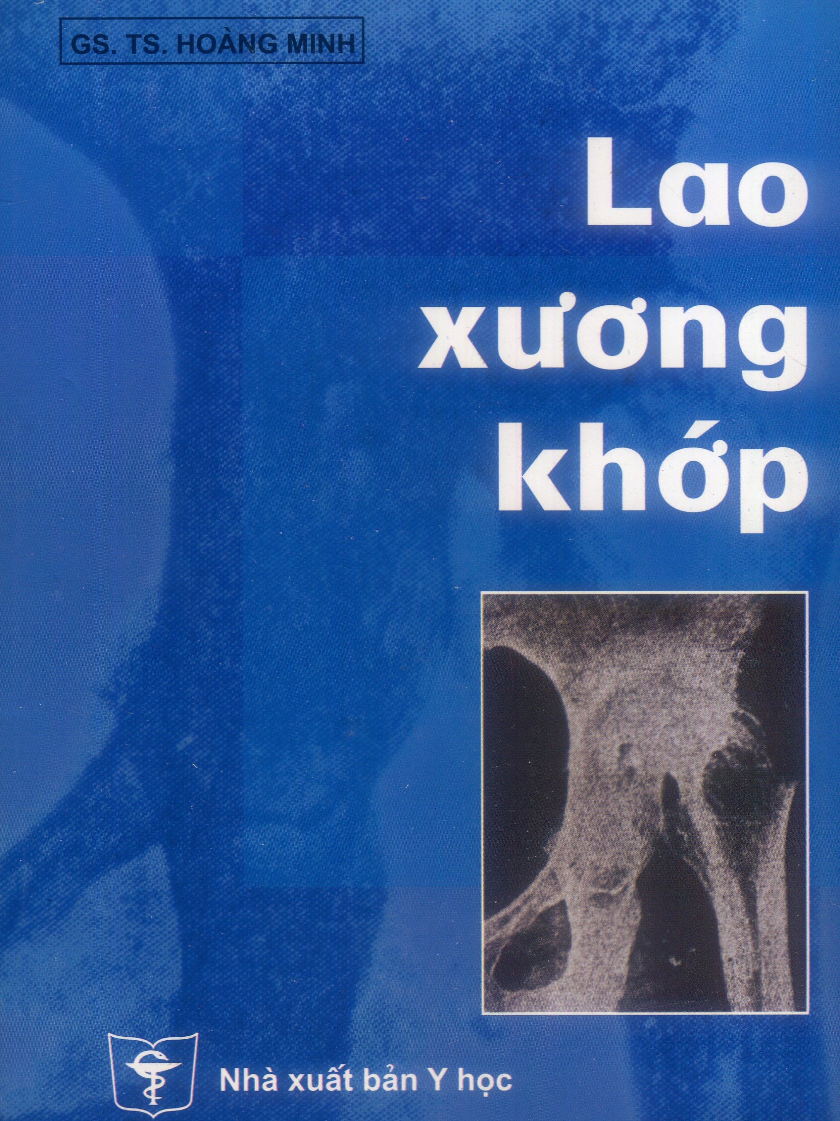 Lao xương khớp