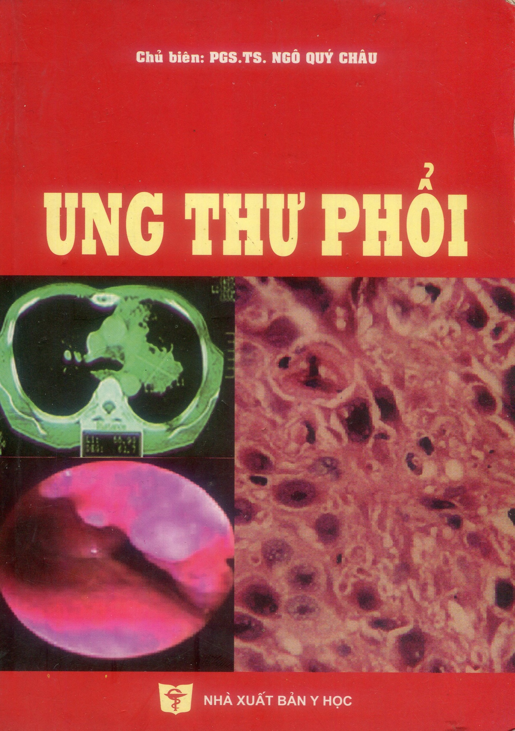 Ung thư phổi