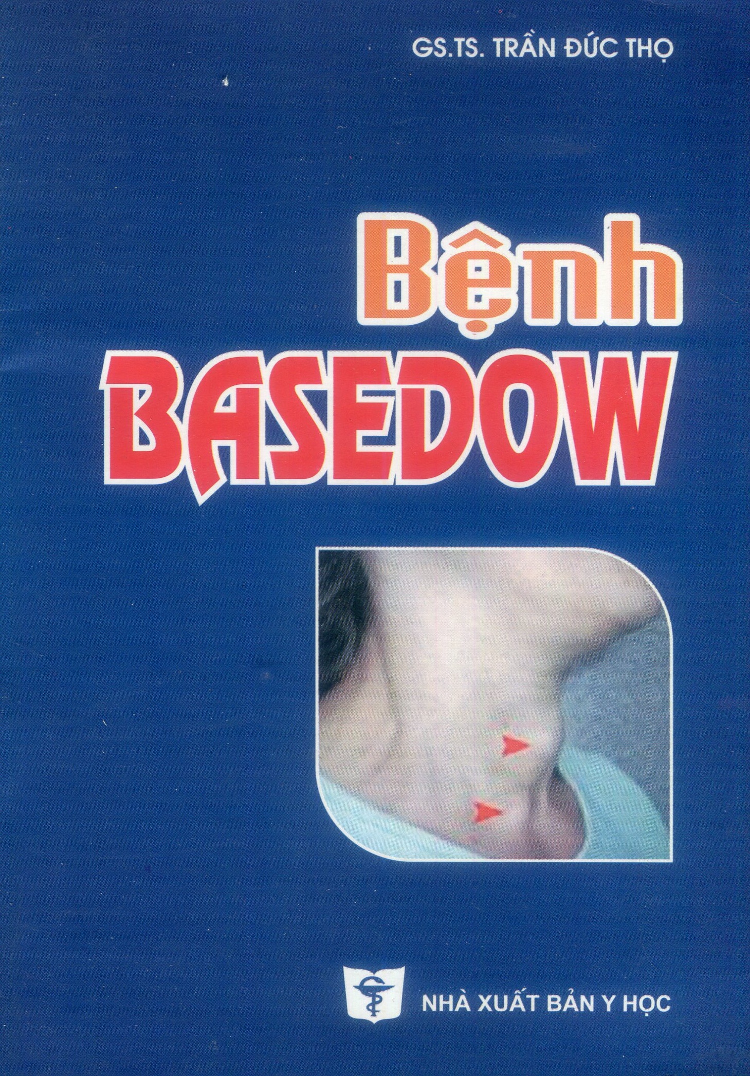 Bệnh Basedow